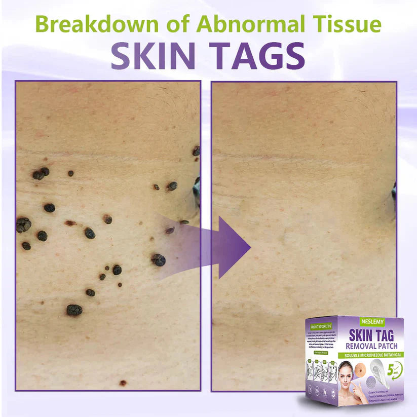 Soluble Microneedle Botanical Skin Tag Removal Patch
