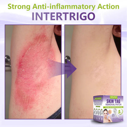 Soluble Microneedle Botanical Skin Tag Removal Patch