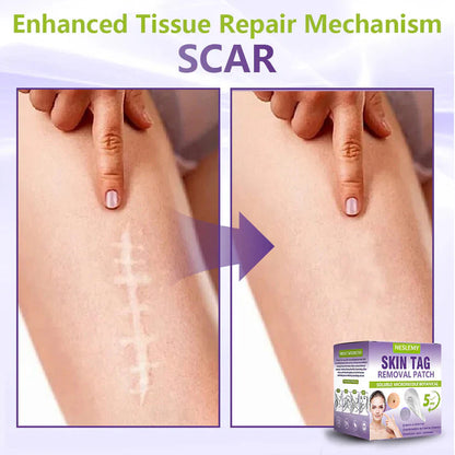 Soluble Microneedle Botanical Skin Tag Removal Patch